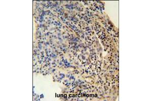 ZNF197 antibody immunohistochemistry analysis in formalin fixed and paraffin embedded human lung carcinoma followed by peroxidase conjugation of the secondary antibody and DAB staining. (ZNF197 antibody  (N-Term))