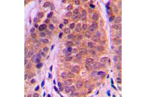 Immunohistochemical analysis of Histone Deacetylase 5 staining in human breast cancer formalin fixed paraffin embedded tissue section. (HDAC5 antibody  (C-Term))