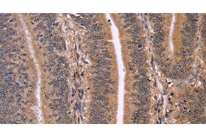 Immunohistochemistry of paraffin-embedded Human colon cancer using CLUAP1 Polyclonal Antibody at dilution of 1:50 (CLUAP1 antibody)