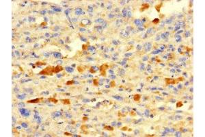 Immunohistochemistry of paraffin-embedded human melanoma using ABIN7156574 at dilution of 1:100 (IFI27L2 antibody  (AA 87-130))