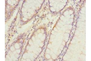 Immunohistochemistry of paraffin-embedded human colon cancer using ABIN7175224 at dilution of 1:100