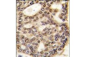 Formalin-fixed and paraffin-embedded human hepatocarcinoma tissue reacted with HDGF antibody (C-term), which was peroxidase-conjugated to the secondary antibody, followed by DAB staining. (HDGF antibody  (C-Term))