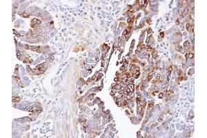 IHC-P Image Immunohistochemical analysis of paraffin-embedded human ovarian cancer, using dynactin 1, antibody at 1:100 dilution. (Dynactin 1 antibody  (C-Term))