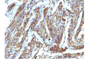Formalin-fixed, paraffin-embedded human Uterus stained with Calponin Rabbit Polyclonal Antibody (CNN1 antibody)