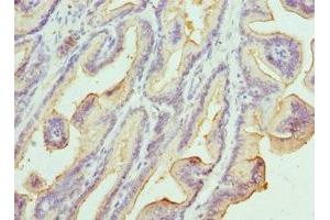 Immunohistochemistry of paraffin-embedded human prostate cancer using ABIN7157198 at dilution of 1:100 (Kallikrein 1 antibody  (AA 35-276))