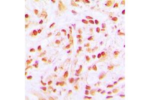Immunohistochemical analysis of CDC16 staining in human lung cancer formalin fixed paraffin embedded tissue section. (CDC16 antibody  (C-Term))