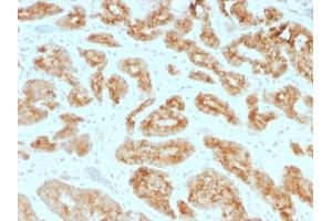 Formalin-fixed, paraffin-embedded human Prostate Carcinoma stained with AMACR / p504S Mouse Monoclonal Antibody (AMACR/1723). (AMACR antibody)