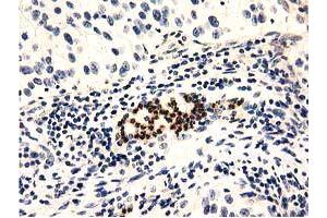 Immunohistochemical staining of paraffin-embedded Carcinoma of Human bladder tissue using anti-GAS7 mouse monoclonal antibody. (GAS7 antibody)