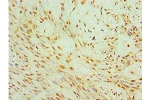 Immunohistochemistry of paraffin-embedded human breast cancer using ABIN7147272 at dilution of 1:100 (CIDEC antibody  (AA 1-238))