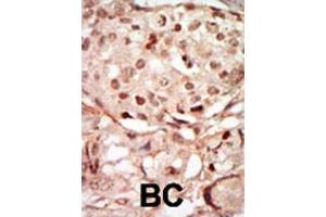 Formalin-fixed and paraffin-embedded human cancer tissue reacted with the primary antibody, which was peroxidase-conjugated to the secondary antibody, followed by DAB staining. (CDK10 antibody  (N-Term))