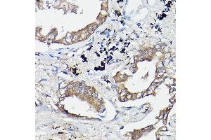 Immunohistochemistry of paraffin-embedded human lung cancer using OL Rabbit pAb (1671) at dilution of 1:100 (40x lens). (OLA1 antibody  (AA 297-396))