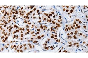 Immunohistochemistry of paraffin-embedded Human lung cancer using MUTYH Polyclonal Antibody at dilution of 1:60 (MUTYH antibody)