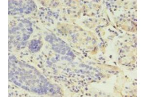 Immunohistochemistry of paraffin-embedded human gastric cancer using ABIN7158812 at dilution of 1:100 (LYZ antibody  (AA 19-148))