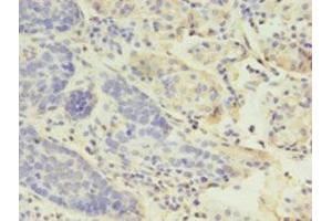 Immunohistochemistry of paraffin-embedded human gastric cancer using ABIN7158812 at dilution of 1:100 (LYZ antibody  (AA 19-148))