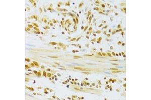 Immunohistochemistry of paraffin-embedded human gastric cancer using HMGB1 Antibody. (HMGB1 antibody  (AA 100-200))