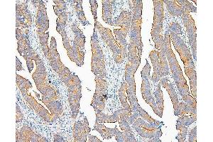 IHC analysis of IQGAP1 using anti-IQGAP1 antibody (ABIN6719262). (IQGAP1 antibody)