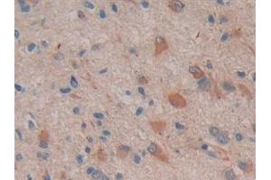 Detection of COX 2 in Human Glioma Tissue using Polyclonal Antibody to Cyclooxygenase-2 (COX 2)