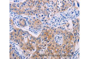 Immunohistochemistry of Human lung cancer using AGT Polyclonal Antibody at dilution of 1:30 (AGT antibody)