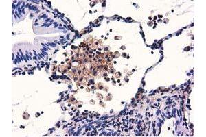 Immunohistochemical staining of paraffin-embedded Carcinoma of Human lung tissue using anti-GAS7 mouse monoclonal antibody. (GAS7 antibody)