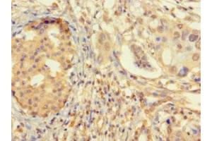 Immunohistochemistry of paraffin-embedded human pancreatic cancer using ABIN7176145 at dilution of 1:100 (ZNF2 antibody  (AA 134-289))