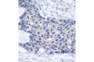 Immunohistochemistry of paraffin-embedded human breast carcinoma tissue, using Phospho-ZAP70-Y493 antibody (ABIN2988352). (ZAP70 antibody  (pTyr493))