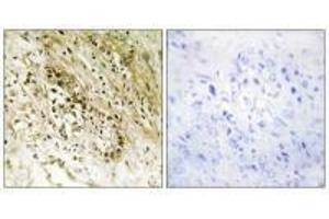 Immunohistochemistry analysis of paraffin-embedded human prostate carcinoma tissue, using PDZD2 antibody. (PDZD2 antibody)