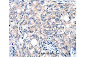 Immunohistochemistry of Human ovarian cancer using GRIN2D Polyclonal Antibody at dilution of 1:30 (GRIN2D antibody)