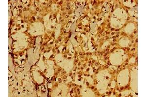 Immunohistochemistry of paraffin-embedded human breast cancer using ABIN7152575 at dilution of 1:100 (FAIM antibody  (AA 1-179))