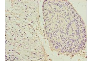 Immunohistochemistry of paraffin-embedded human cervical cancer using ABIN7157360 at dilution of 1:100 (Keratin 33B antibody  (AA 1-404))