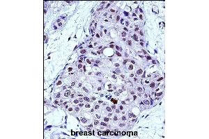 MYB Antibody (Center) (ABIN657911 and ABIN2846859) immunohistochemistry analysis in formalin fixed and paraffin embedded human breast carcinoma followed by peroxidase conjugation of the secondary antibody and DAB staining. (MYB antibody  (AA 419-448))