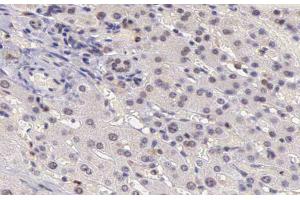 ABIN6266503 at 1/200 staining human liver carcinoma tissue sections by IHC-P. (CARD6 antibody  (N-Term))