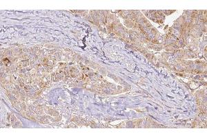 ABIN6267131 at 1/100 staining Human thyroid cancer tissue by IHC-P. (KIF1B antibody  (pSer1487))