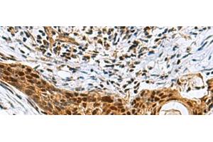 Immunohistochemistry of paraffin-embedded Human esophagus cancer tissue using NABP1 Polyclonal Antibody at dilution of 1:80(x200) (OBFC2A antibody)