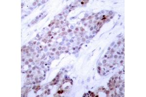 Immunohistochemistry of paraffin-embedded human breast carcinoma using Phospho-ATF4-S245 antibody (ABIN2987890). (ATF4 antibody  (pSer245))