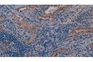Detection of MMP11 in Human Thyroid cancer Tissue using Polyclonal Antibody to Matrix Metalloproteinase 11 (MMP11) (MMP11 antibody  (AA 277-488))