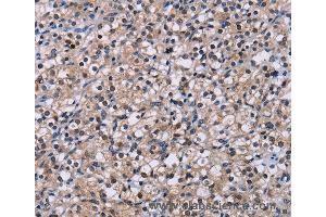 Immunohistochemistry of Human liver cancer using NR1D1 Polyclonal Antibody at dilution of 1:60 (NR1D1 antibody)