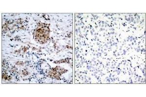 Immunohistochemical analysis of paraffin-embedded human breast carcinoma tissue using Estrogen Receptor-a(Phospho-Ser167) Antibody(left) or the same antibody preincubated with blocking peptide(right). (Estrogen Receptor alpha antibody  (pSer167))