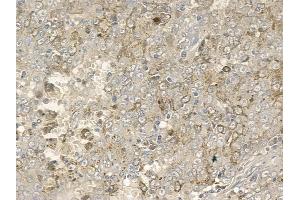 ABIN6256710 and ABIN6267163 at 1/100 staining human melanoma by IHC-P. (DLG2 antibody  (pTyr340))