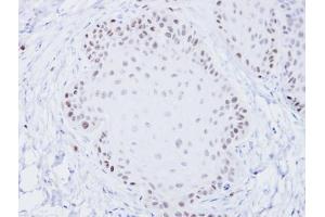 IHC-P Image Immunohistochemical analysis of paraffin-embedded Cal27 xenograft, using BLM, antibody at 1:100 dilution.