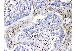 VASP was detected in paraffin-embedded sections of human lung cancer tissues using rabbit anti- VASP Antigen Affinity purified polyclonal antibody (Catalog # ) at 1 µg/mL. (VASP antibody  (N-Term))