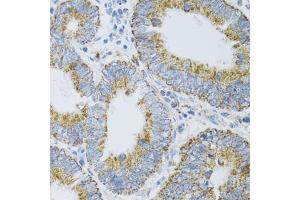 Immunohistochemistry of paraffin-embedded human rectal cancer using PDYN antibody (ABIN5974999) at dilution of 1/100 (40x lens). (PDYN antibody)