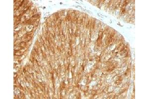 Formalin-fixed, paraffin-embedded human bladder carcinoma stained with Beta-2-Microglobulin antibody. (beta-2 Microglobulin antibody)