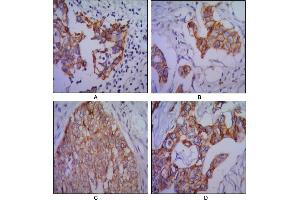 Immunohistochemical analysis of paraffin-embedded human lung cancer (A), colon cancer (B), ovarian cancer (C) and mammary cancer(D), using CDH2 mouse mAb with DAB staining. (N-Cadherin antibody)