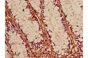 Immunohistochemistry of paraffin-embedded human colon cancer using ABIN7153058 at dilution of 1:100