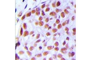 Immunohistochemical analysis of TAF5L staining in human breast cancer formalin fixed paraffin embedded tissue section. (TAF5L antibody)