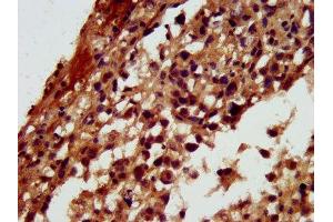 IHC image of ABIN7167616 diluted at 1:300 and staining in paraffin-embedded human melanoma performed on a Leica BondTM system. (RGS6 antibody  (AA 177-262))
