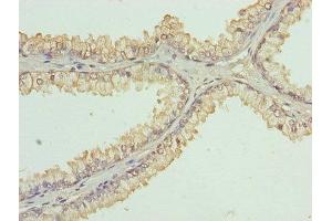 Immunohistochemistry of paraffin-embedded human prostate cancer using ABIN7158708 at dilution of 1:100 (KDM5A antibody  (AA 437-603))