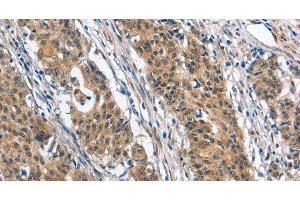 Immunohistochemistry of paraffin-embedded Human gastric cancer tissue using BNIP3L Polyclonal Antibody at dilution 1:40 (BNIP3L/NIX antibody)