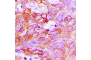 Immunohistochemical analysis of Ephrin A1 staining in human breast cancer formalin fixed paraffin embedded tissue section.