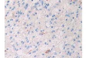 Detection of Slit1 in Human Glioma Tissue using Polyclonal Antibody to Slit Homolog 1 (Slit1) (SLIT1 antibody  (AA 647-835))